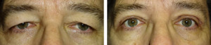 Upper-eyelid-blepharoplasty-2