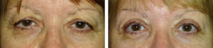 Upper-eyelid-blepharoplasty-with-internal-browpexy