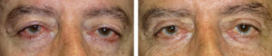 Upper-eyelid-blepharoplasty-internal-browpexy