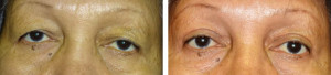 asian-upper-eyelid-blepharoplasty