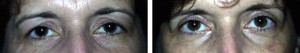 cosmetic-surgery-upper-eyelid
