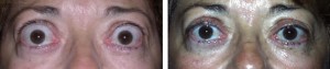 repair-of-eyelid-retraction