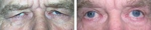 upper-and-lower-lid-blepharoplasty-with-brow-lift