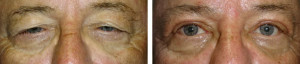upper-eyelid-blepharoplasty