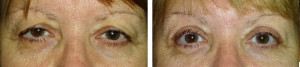 upper-eyelid-blepharoplasty-internal-browpexy